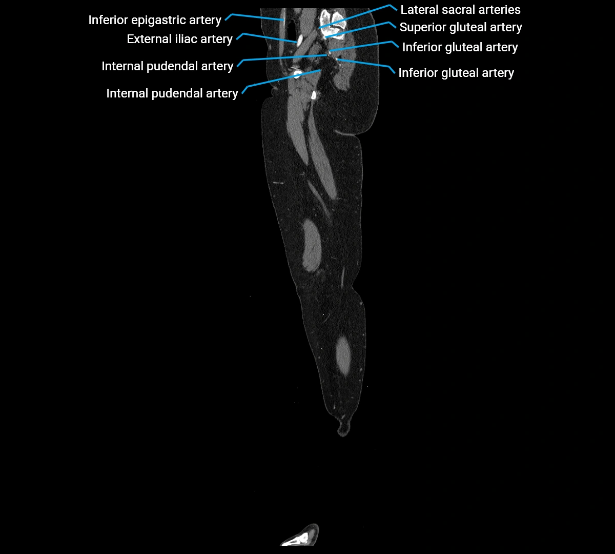 CTA lower limb sagittal cross sectional anatomy labelled image _17 (3).webp
